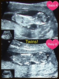 Here our twins are lying with their heads on the right side of the image, with their backs to us, folded up in the fetal position.